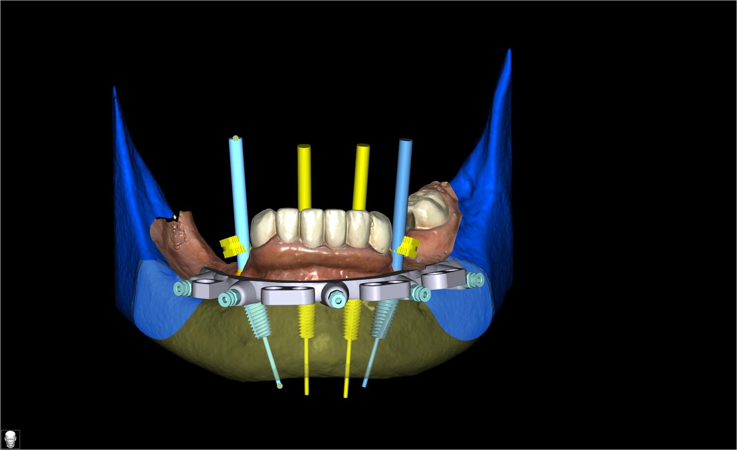 Rehberli implant cerrahisine ilişkin üç boyutlu planlama görseli